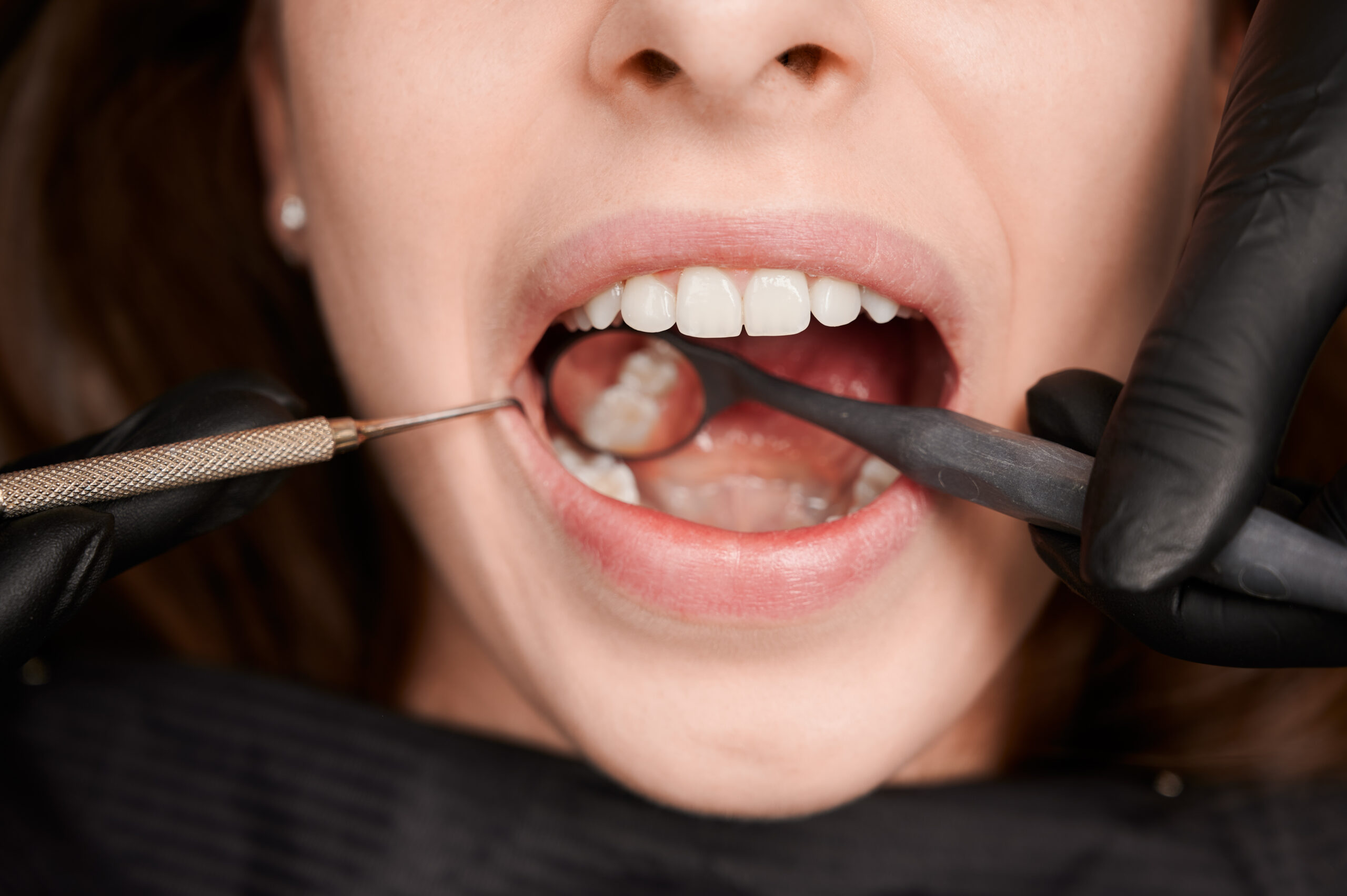 Dental filling being examined in Indianapolis
