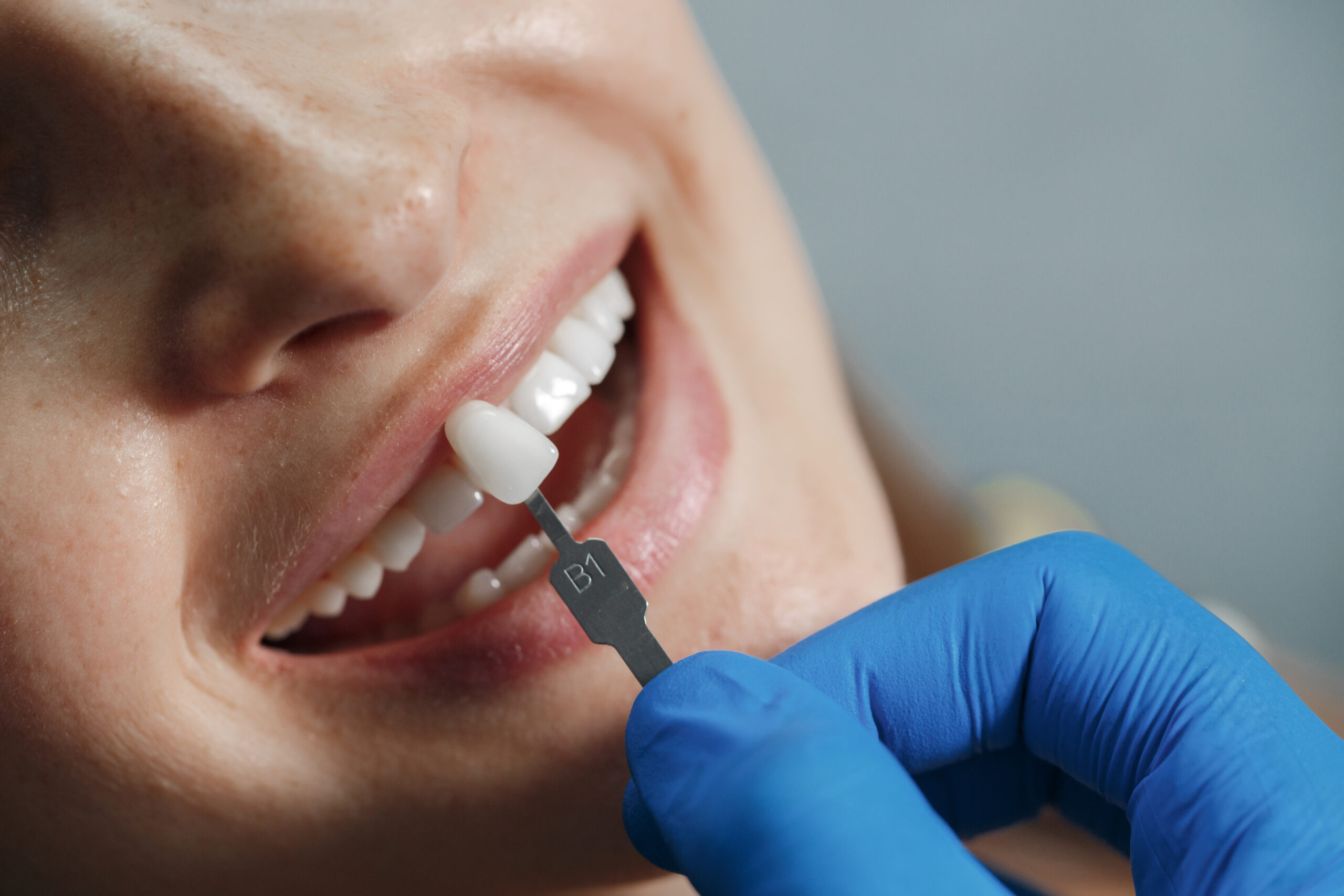 Woman being shown dental veneers