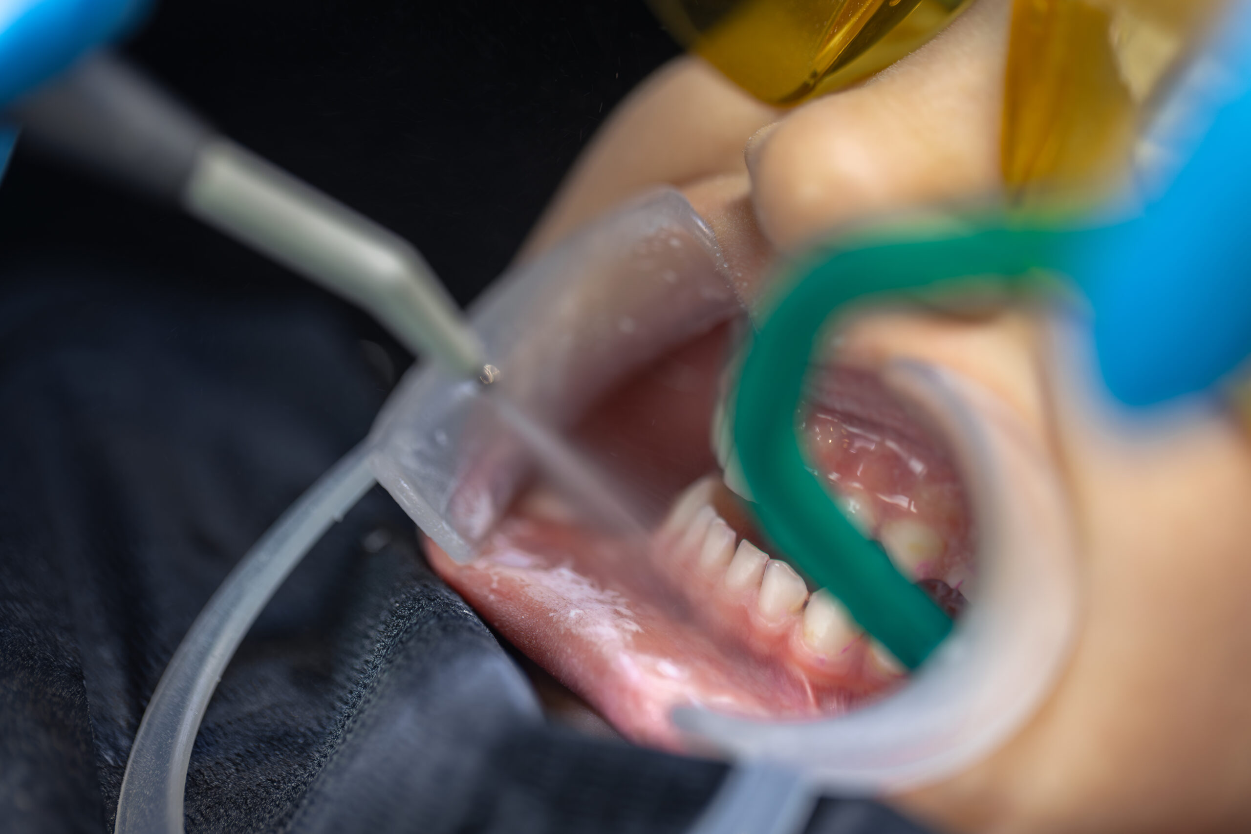 Periodontitis being treated by a gum cleaning dentist