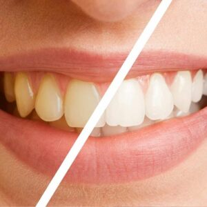 Before and After Teeth Whitening