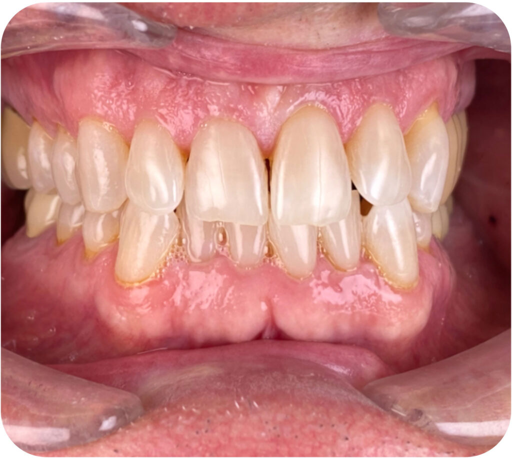 After: Smile after treatment, transformation 4