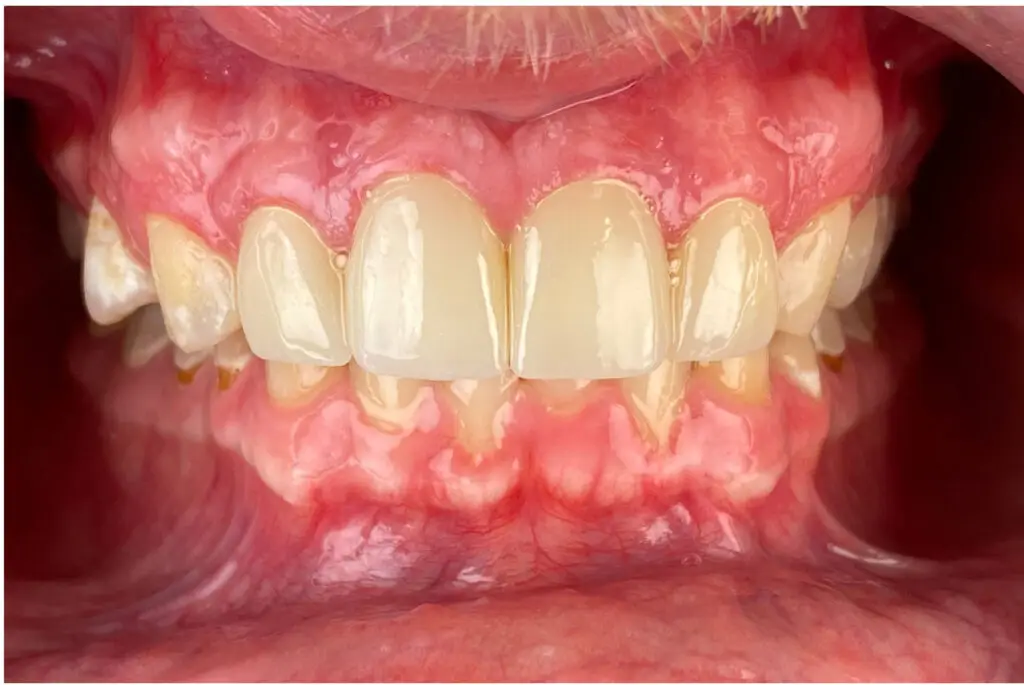 After: Smile after treatment, transformation 5