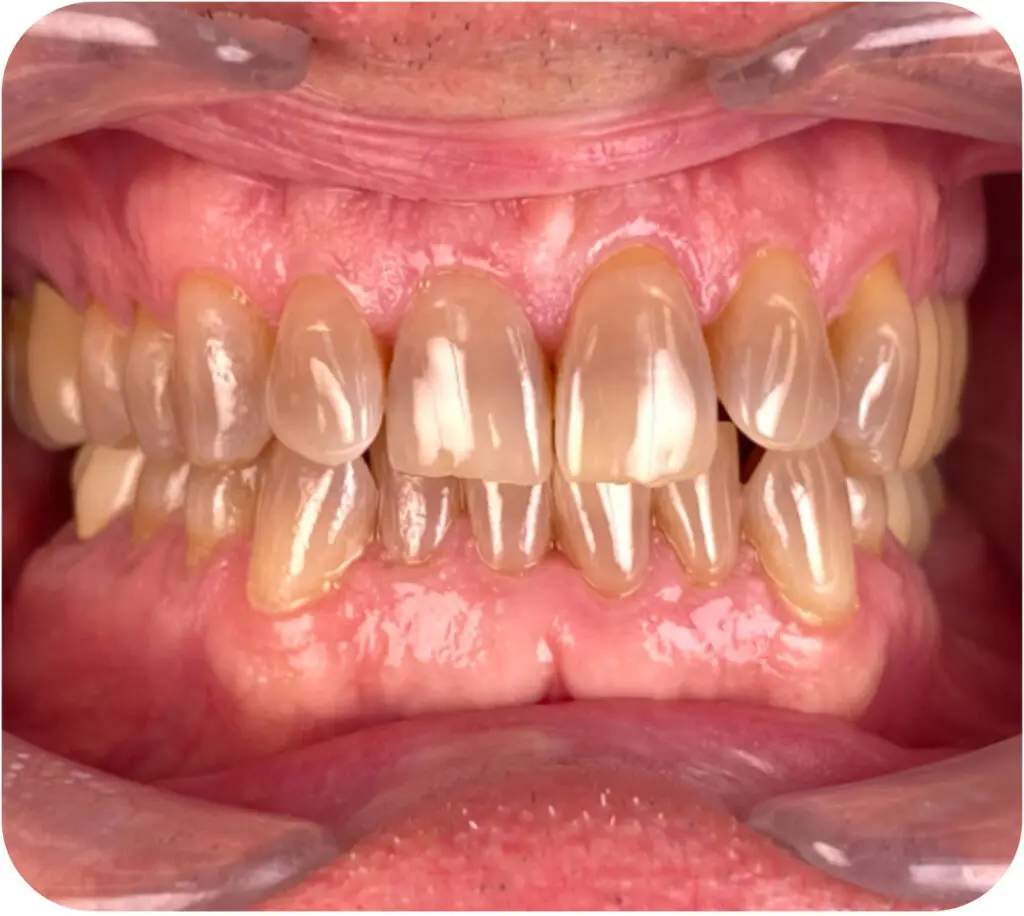 Before: Smile before treatment, transformation 4