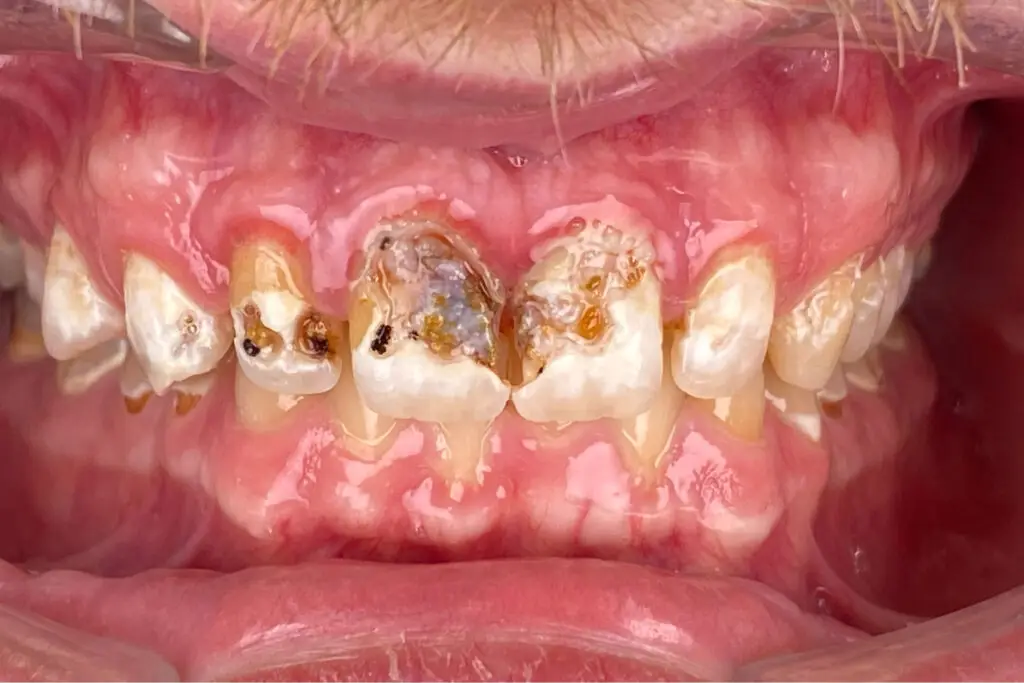 Before: Smile before treatment, transformation 5